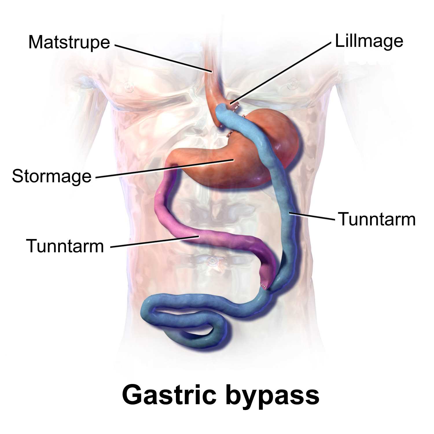 gastric bypass skåne kriterier gastric bypass skåne kriterier